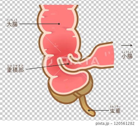 Intussusception, illustration 120561282