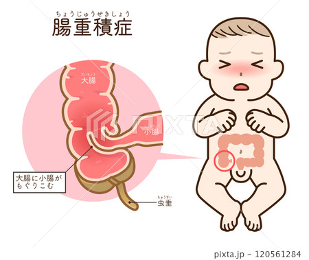 腸重積症、Intussusception、イラスト 120561284