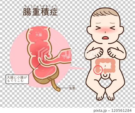 腸套疊，插圖 120561284