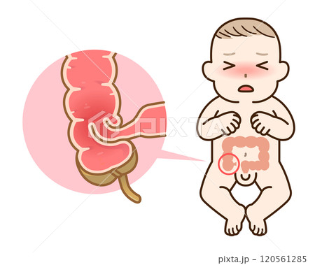 腸重積症、Intussusception、イラスト 120561285