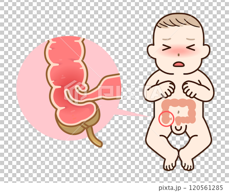 Intussusception, illustration 120561285