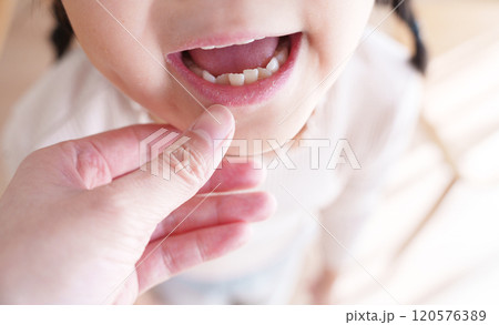 歯並びが悪い子供の口元 120576389