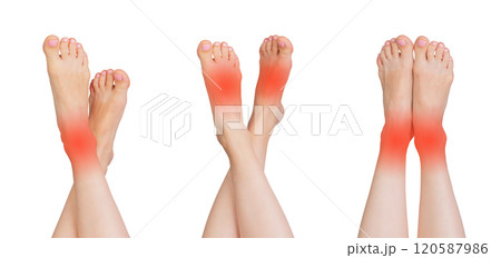 Set of female feet showing signs of pain, injury, and inflammation, including redness and swelling. Set of female feet showing signs of pain, injury, and inflammation, including redness and swelling. 120587986
