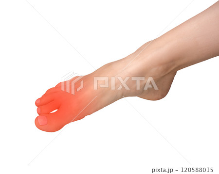 Foot pain with inflamed joint and neuropathy. Big toe ache, cramp, or strain caused by arthritis, Foot pain with inflamed joint and neuropathy. Big toe ache, cramp, or strain caused by arthritis, 120588015