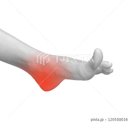 Foot pain and inflammation. Sore heel and joint injury causing chronic ache or neuropathy. Medical 120588016