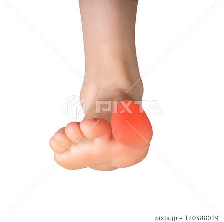 Foot pain and discomfort. Injured toe and joint suffering from inflammation, arthritis, or strain. Foot pain and discomfort. Injured toe and joint suffering from inflammation, arthritis, or strain. 120588019