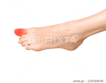 Big toe pain, joint ache, and inflammation. Sore foot with sprain, tendon bruise, and calcaneal Big toe pain, joint ache, and inflammation. Sore foot with sprain, tendon bruise, and calcaneal 120588036