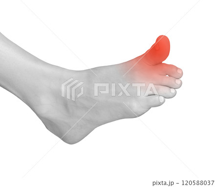 Big toe pain, foot contusion from strain or injury. Sore, tensed joints with neuropathy or arthritis 120588037
