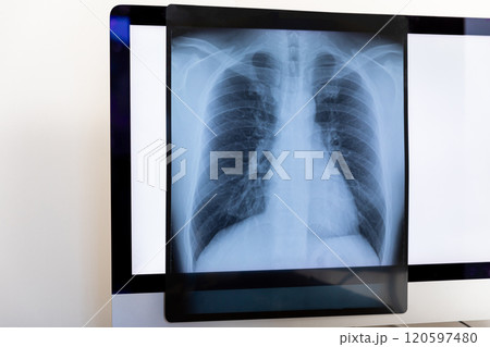 レントゲン X-ray レントゲン X-ray 120597480