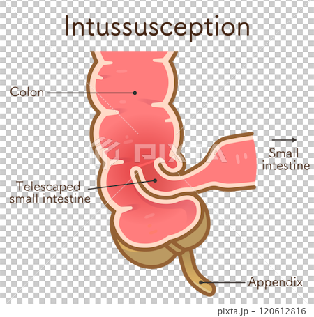 Intussusception, illustration Intussusception, illustration 120612816