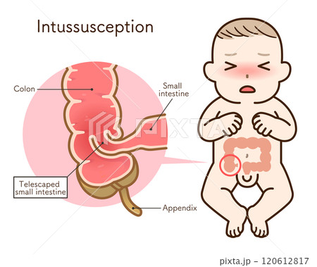 腸重積症、Intussusception、イラスト 腸重積症、Intussusception、イラスト 120612817