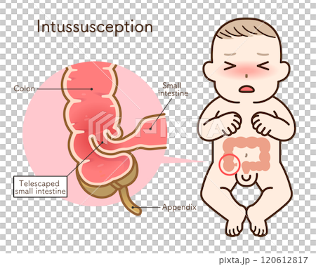 腸重積症、Intussusception、イラスト 腸重積症、Intussusception、イラスト 120612817