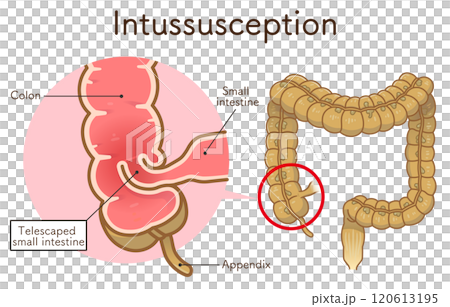 腸套疊，插圖 120613195