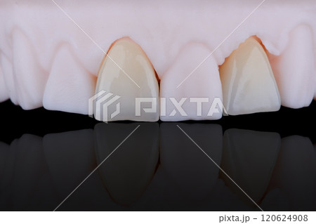 High-quality naturally dental single crowns made of zirconium for fixation to the frontal teeth of upper jaw. High-quality naturally dental single crowns made of zirconium for fixation to the frontal teeth of upper jaw. 120624908