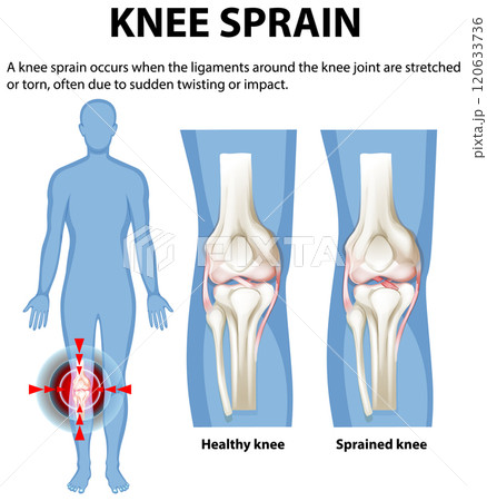 Understanding Knee Sprain and Ligament Injury Understanding Knee Sprain and Ligament Injury 120633736