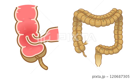腸重積症、Intussusception、イラスト 120687305