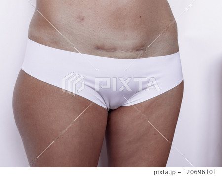 Close up of surgical scar on abdomen in white underwear Close up of surgical scar on abdomen in white underwear 120696101