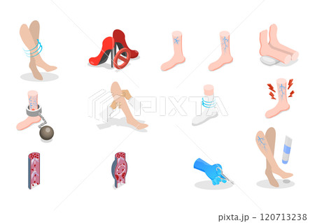 3D Isometric Flat  Set of Varicose Treatment, Health Care 120713238