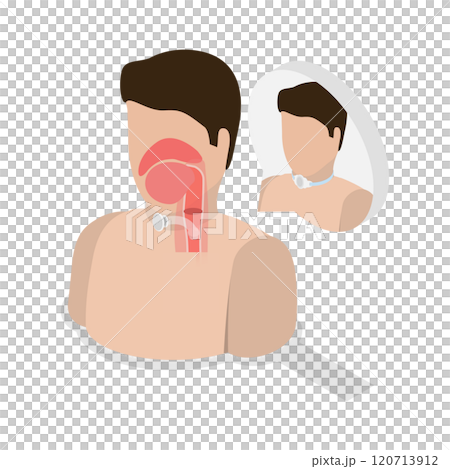 3D Isometric Flat Illustration of Tracheostomy, Tracheal Surgery 3D Isometric Flat Illustration of Tracheostomy, Tracheal Surgery 120713912