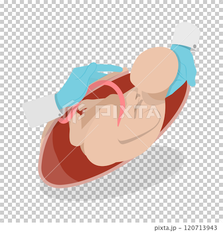3D Isometric Flat  Illustration of Cesarean Section, Medical Surgery and Abdominal Incision 120713943