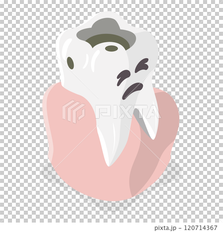 3D Isometric Flat Illustration of Tooth Decay. Item 2 3D Isometric Flat Illustration of Tooth Decay. Item 2 120714367
