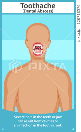Understanding Toothache and Dental Abscess 120718576