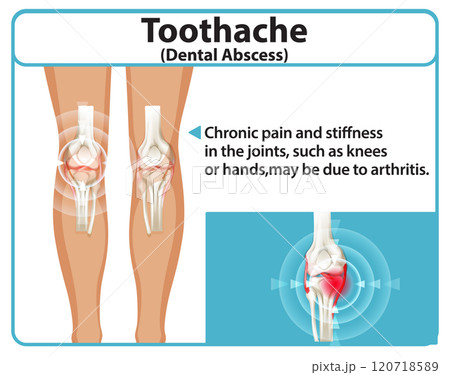 Knee Joint Pain and Arthritis Illustration Knee Joint Pain and Arthritis Illustration 120718589