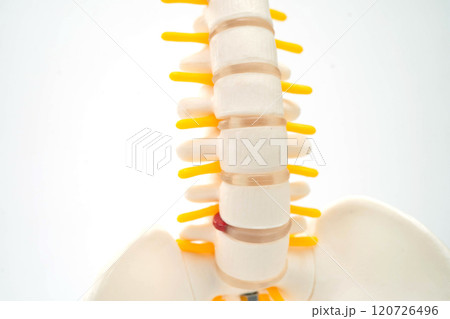 Spinal nerve and bone, Lumbar spine displaced herniated disc fragment, Model for treatment medical in the orthopedic department. Spinal nerve and bone, Lumbar spine displaced herniated disc fragment, Model for treatment medical in the orthopedic department. 120726496