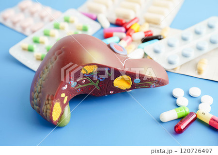 Liver model with pill drug treatment, Cirrhosis, Liver cancer, fatty liver. Liver model with pill drug treatment, Cirrhosis, Liver cancer, fatty liver. 120726497