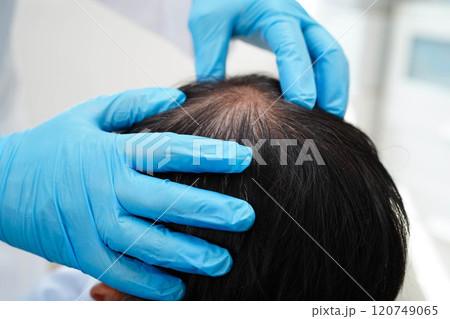 Doctor touch bold head in man, hair loss treatment health problem. 120749065