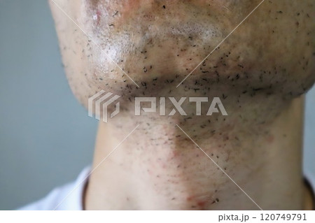 レーザー脱毛直後の日本人男性の肌 120749791