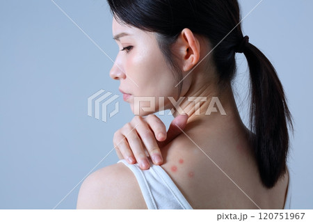 背中ニキビに悩む女性イメージ 120751967