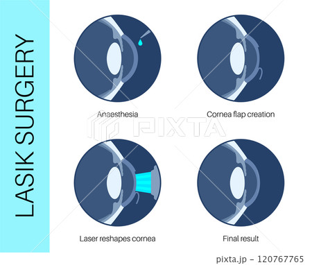 LASIK eye surgery 120767765