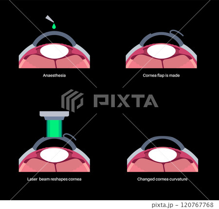 LASIK eye surgery LASIK eye surgery 120767768
