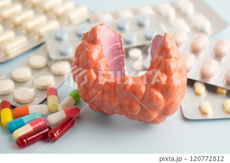 Thyroid model with pill drug treatment, Hyperthyroidism, Overactive or Lymphoma. Thyroid model with pill drug treatment, Hyperthyroidism, Overactive or Lymphoma. 120772812