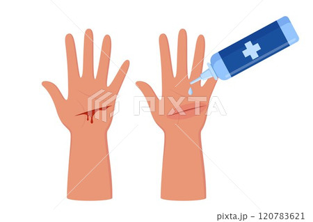 Bleeding cut on the palm, emergency situation. First aid treatment for wound on skin. Trauma, treatment procedure. Vector illustration. Bleeding cut on the palm, emergency situation. First aid treatment for wound on skin. Trauma, treatment procedure. Vector illustration. 120783621