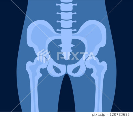 XRay of hip joint pelvis human bones anatomy orthopedic medical diagnostic. X ray roentgen radiology shot surgery femur healthy skeleton spine anatomical structure image. Vector illustration. XRay of hip joint pelvis human bones anatomy orthopedic medical diagnostic. X ray roentgen radiology shot surgery femur healthy skeleton spine anatomical structure image. Vector illustration. 120783655