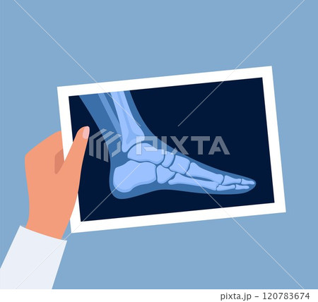 X ray human foot. X-ray picture or radiographic monitor image of metatarsus bones and toes. Medical radiology. Roentgen shot in doctors hand. Vector illustration. 120783674