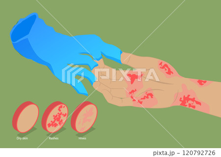 3D Isometric Flat Vector Illustration of Latex Allergy, Skin Reactions From Chemical Exposure 120792726