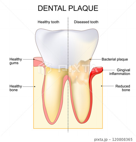 Dental plaque. Gingival inflammation. Close-up of a Tooth 120808365