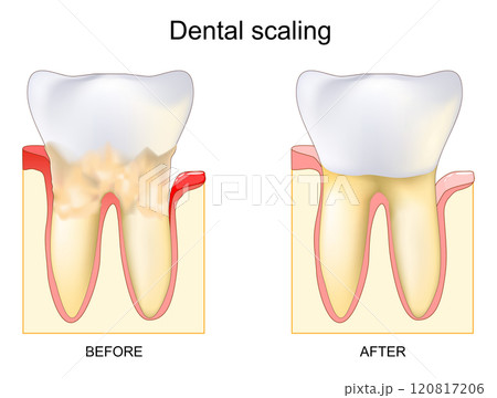Dental calculus. Professional cleaning or scaling. removing tartar Dental calculus. Professional cleaning or scaling. removing tartar 120817206