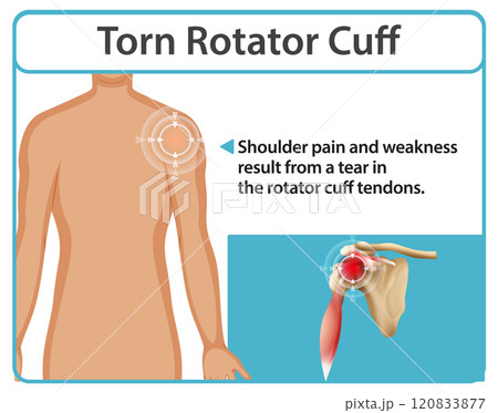 Understanding Torn Rotator Cuff Injuries 120833877