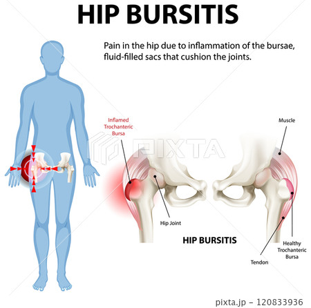 Understanding Hip Bursitis and Its Effects 120833936