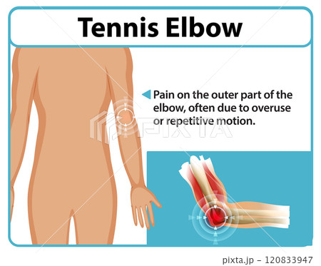 Understanding Tennis Elbow Pain 120833947