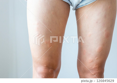 Young asian man has allergic skin rash on his legs from itchy dry skin eczema dermatitis insect bites 120845629
