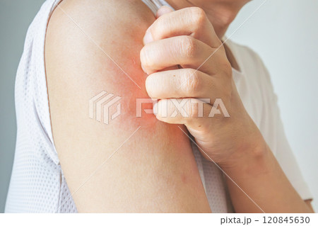 Young asian man itching and scratching on arm from allergic itchy dry skin eczema dermatitis insect bites Young asian man itching and scratching on arm from allergic itchy dry skin eczema dermatitis insect bites 120845630