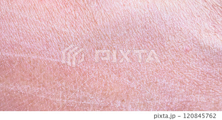 dry and dehydrated human skin texture background 120845762