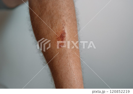 Scratch marks on skin surface cause by sharp fingernails scratching an itch, closeup macro view. Scar on a man's thigh caused by scratching on itchy skin. Healing cut wound on a person's flesh. 120852219