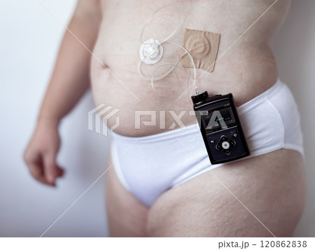 Person with insulin pump and glucose monitor for diabetes management 120862838