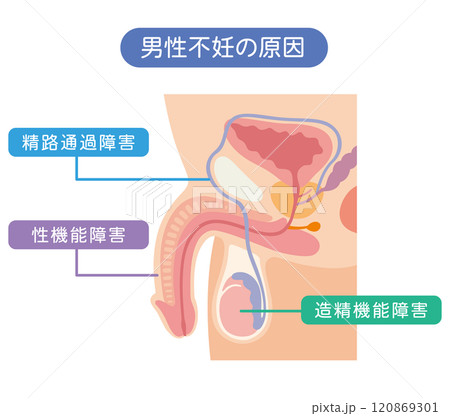 男性不妊の原因　不妊症　生殖医療 120869301